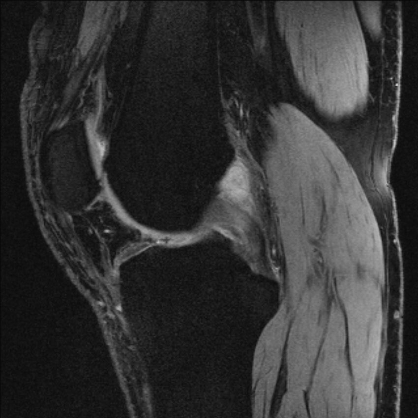 Anterior cruciate ligament mucoid degeneration (Radiopaedia 68400-77933 Sagittal 37).jpg
