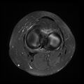 Anterior cruciate ligament tear, Wrisberg rip and bucket-handle tear of medial meniscus (Radiopaedia 75872-87266 Axial PD fat sat 10).jpg