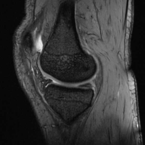 File:Anterior cruciate ligament tear - ramp lesion (Radiopaedia 71883-82322 Sagittal T2 fat sat 17).jpg