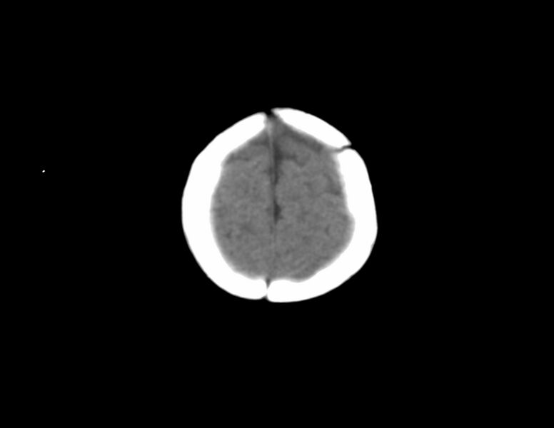 File:Anterior plagiocephaly (Radiopaedia 71836-82273 Axial non-contrast 19).jpg