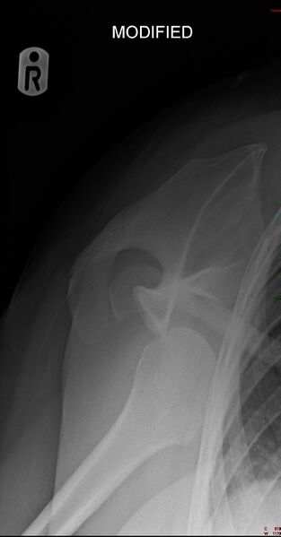 File:Anterior shoulder dislocation (Radiopaedia 63139-71656 Modified axial 1).jpg