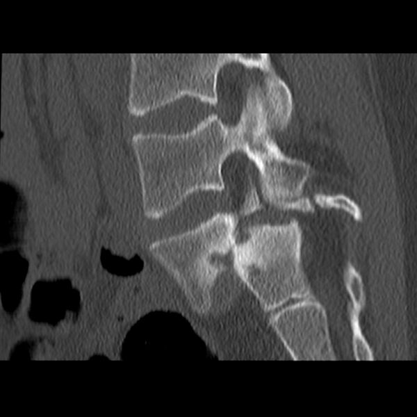 File:Anterolisthesis (Radiopaedia 22226-22263 Sagittal bone window 14).jpg