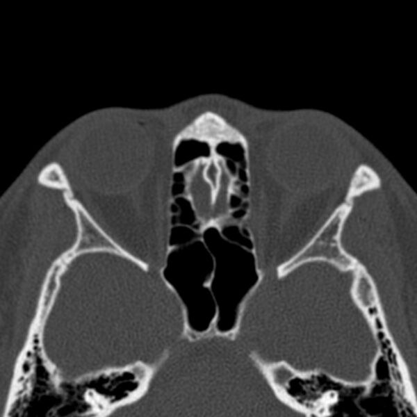 File:Antrochoanal polyp (Radiopaedia 33984-35202 Axial bone window 55).jpg
