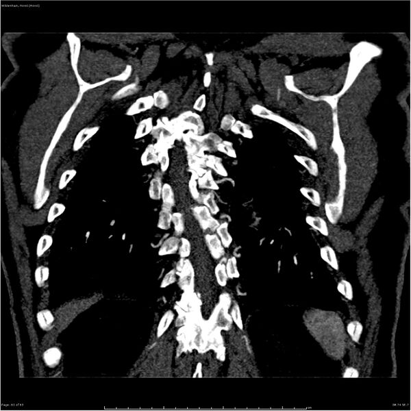 File:Aortic dissection - Stanford type A (Radiopaedia 26183-26315 A 61).jpg