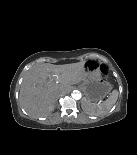 File:Aortic dissection with renal ischemia (Radiopaedia 76573-88338 A 58).jpg
