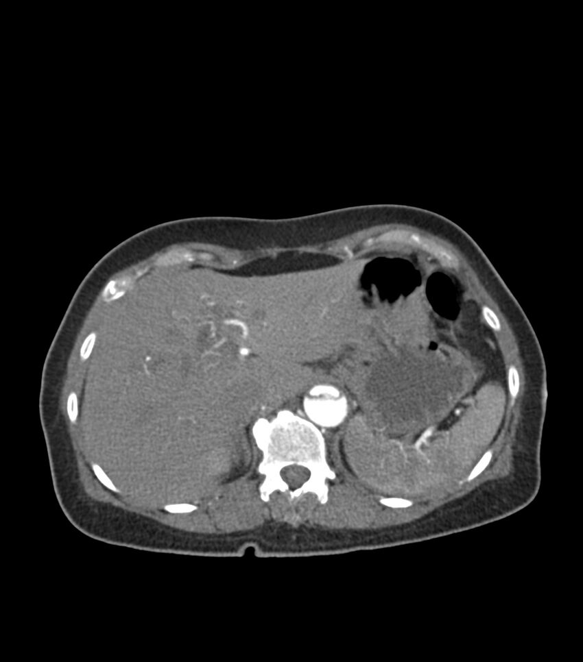 Aortic dissection with renal ischemia (Radiopaedia 76573-88338 A 58).jpg