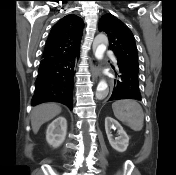 File:Aortic dissection with rupture into pericardium (Radiopaedia 12384-12647 B 31).jpg