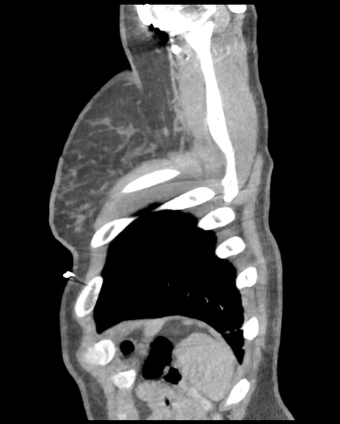 File:Aortic valve non-coronary cusp thrombus (Radiopaedia 55661-62189 D 6).png