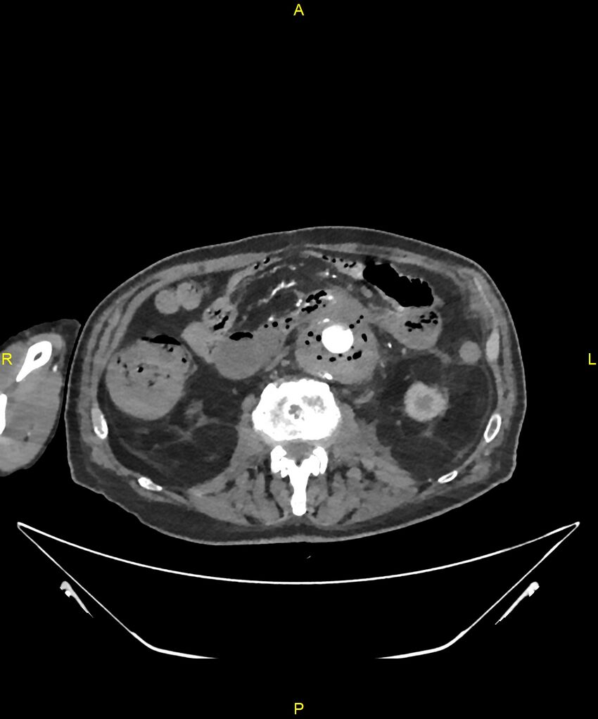 Aortoenteric fistula (Radiopaedia 84308-99603 B 167).jpg