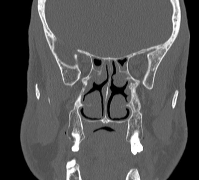 File:Aplastic maxillary sinuses (Radiopaedia 60030-67561 Coronal non-contrast 24).jpg