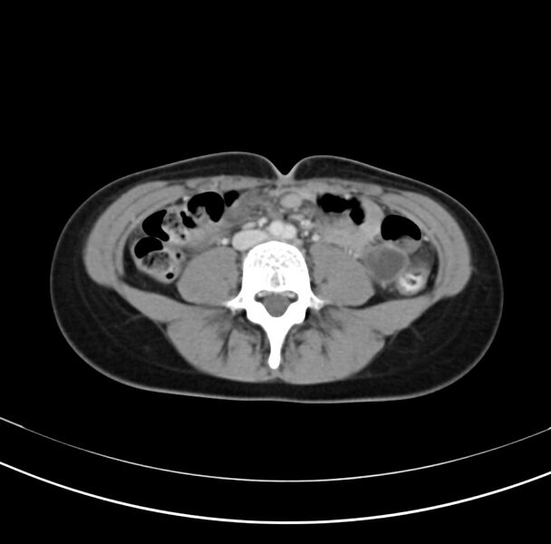 File:Appendicitis and incidental bicornuate uterus (Radiopaedia 22833-22853 B 26).jpg