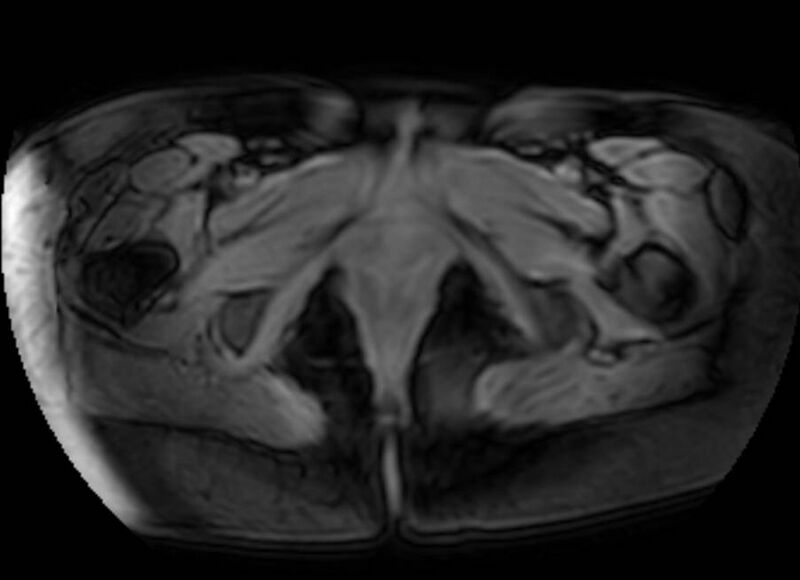 File:Appendicitis in gravida (MRI) (Radiopaedia 89433-106395 Axial DIXON 157).jpg