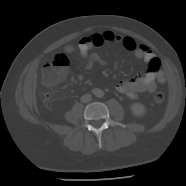 File:Appendicitis with perforation (Radiopaedia 35790-37342 Axial bone window 29).jpg