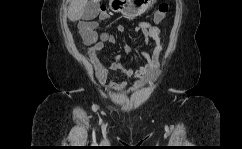 Appendix mucocele (Radiopaedia 41222-44033 B 8).jpg