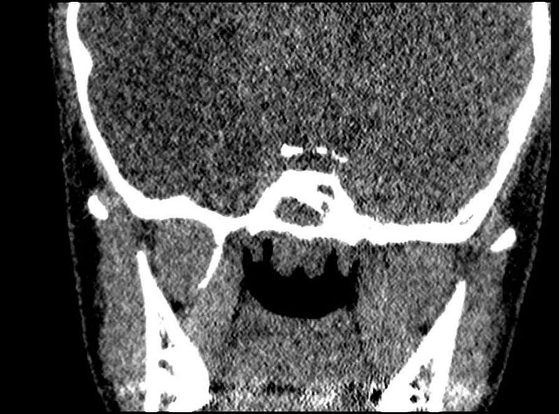 File:Arachnoid cyst- extremely large (Radiopaedia 68741-78450 Coronal bone window 12).jpg