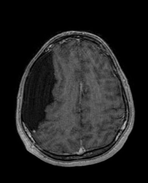 File:Arachnoid cyst- extremely large (Radiopaedia 68741-78451 Axial T1 C+ 60).jpg