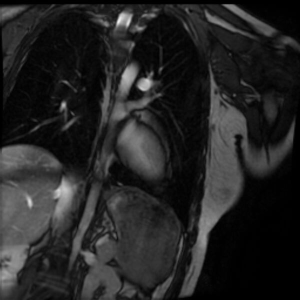 File:Arrhythmogenic right ventricular cardiomyopathy (Radiopaedia 87505-103850 2ch (LV) Cine SSFP 63).jpg