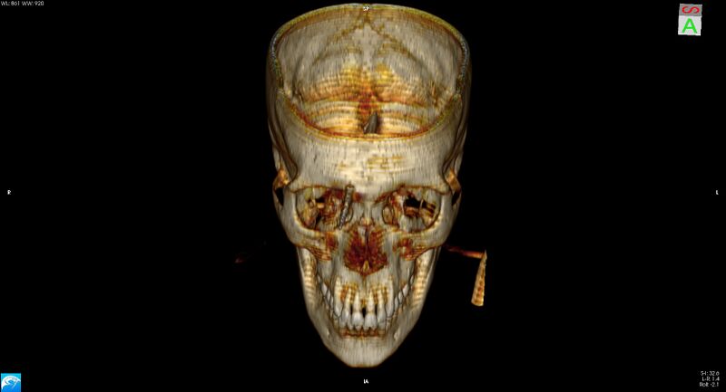 File:Arrow injury to the brain (Radiopaedia 72101-82607 3D bone 9).jpg