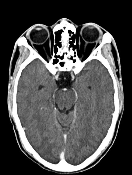 File:Arrow injury to the face (Radiopaedia 73267-84011 Axial C+ delayed 47).jpg