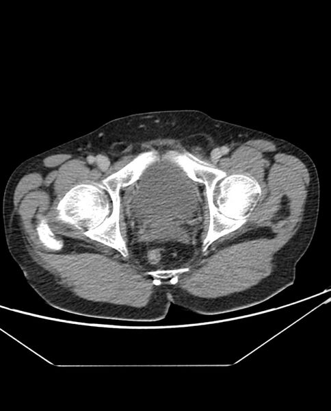 File:Arterial occlusive mesenteric ischemia (Radiopaedia 84641-100054 A 115).jpg