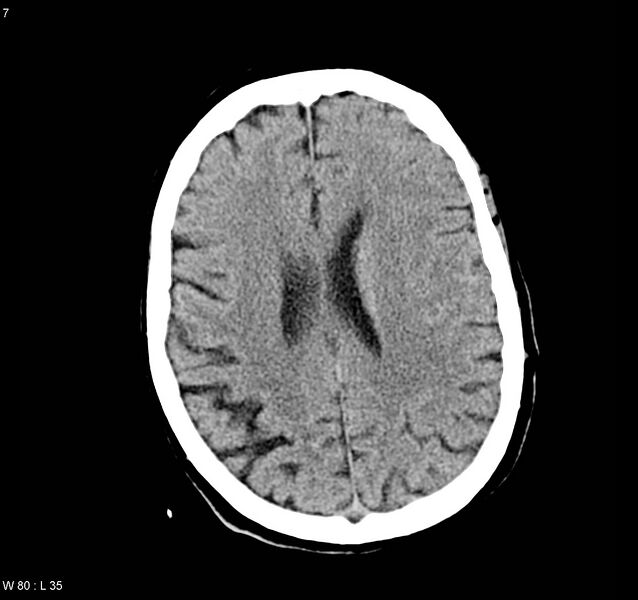 File:Arteriovenous malformation - cerebral (Radiopaedia 8172-9020 Axial non-contrast 15).jpg