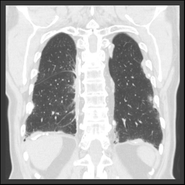 File:Asbestos-related pleural plaques (Radiopaedia 39069-41255 Coronal lung window 18).jpg