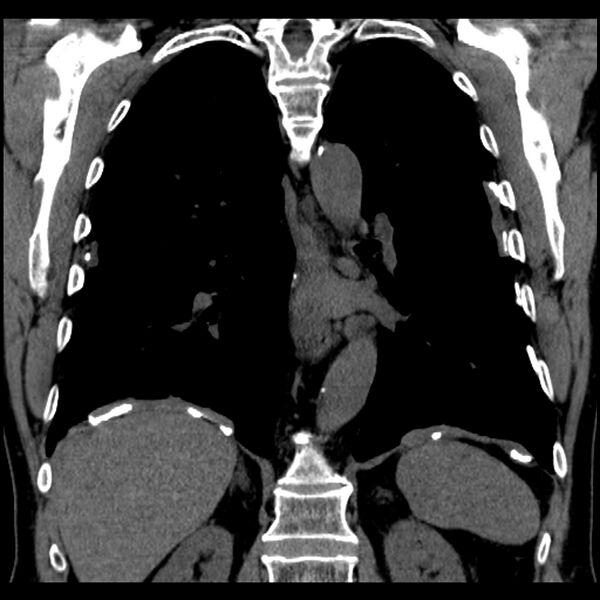 File:Asbestos-related pleural plaques (Radiopaedia 39069-41255 Coronal non-contrast 31).jpg
