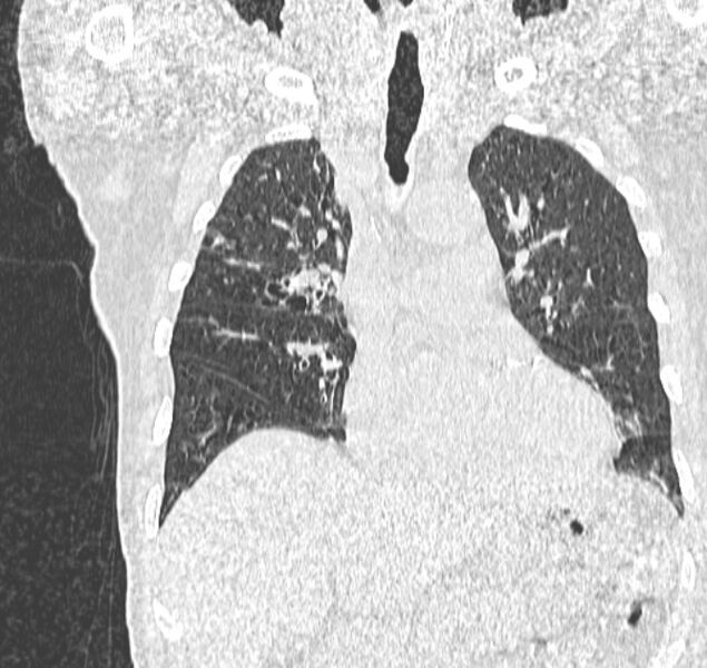 File:Aspergilloma (Radiopaedia 44592-48327 Coronal lung window 50).jpg