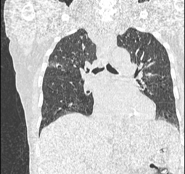File:Aspergilloma (Radiopaedia 44592-48327 Coronal lung window 65).jpg