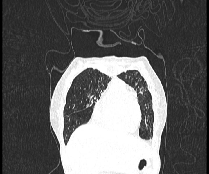 File:Aspergillomas (Radiopaedia 66779-76110 Coronal lung window 3).jpg