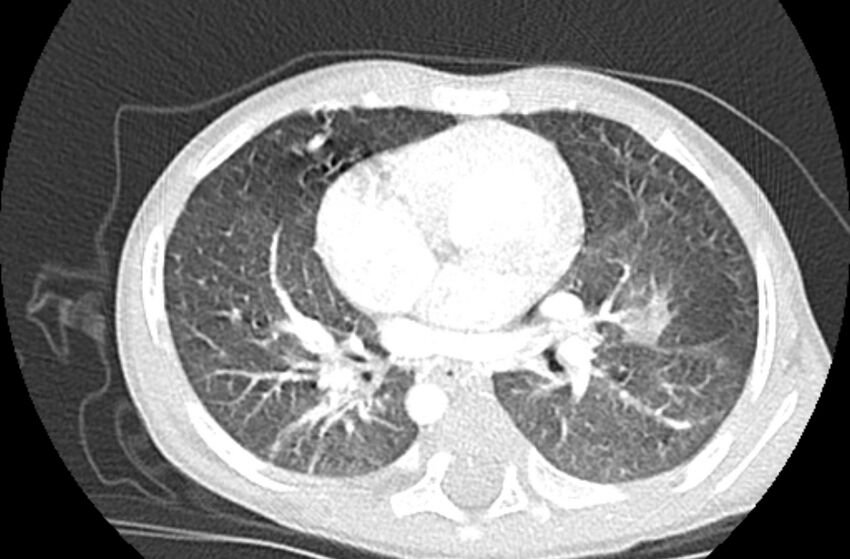Asplenia syndrome (Radiopaedia 73083-83792 Axial lung window 36).jpg