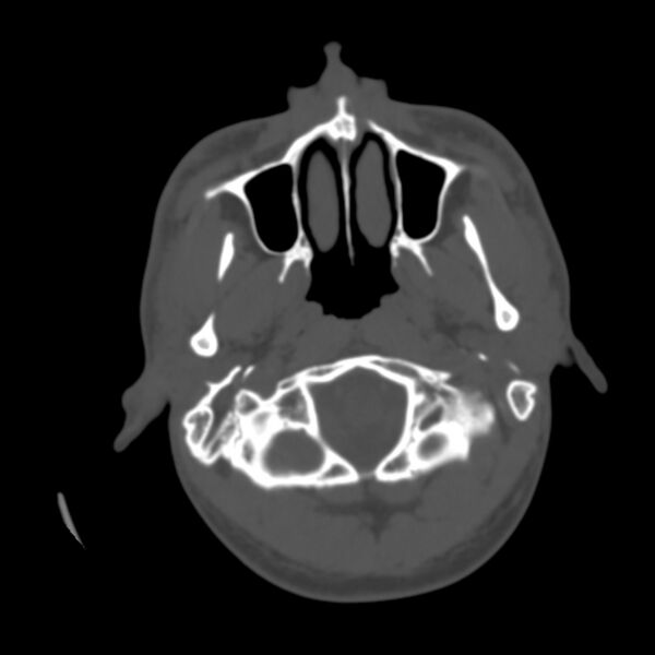 File:Asymptomatic occipital spur (Radiopaedia 87753-104201 Axial bone window 4).jpg