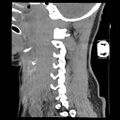 Atlanto-occipital dislocation (Radiopaedia 44648-48412 A 21).jpg