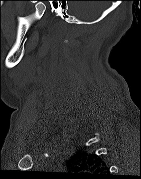 File:Atlanto-occipital dissociation - Traynelis type 1 (Radiopaedia 87570-103948 Sagittal bone window 64).jpg
