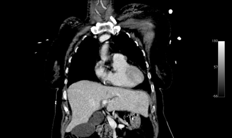 File:Atypical dissection of the thoracic aorta (Radiopaedia 10975-78320 B 1).jpg