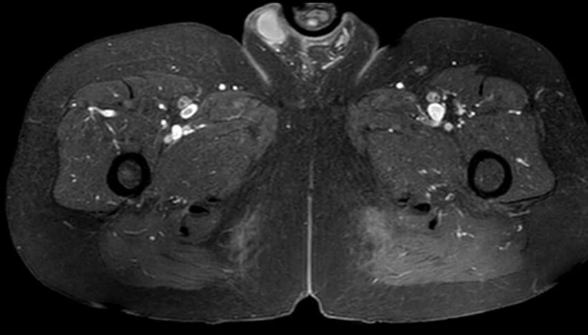 Atypical lipomatous tumor - thigh (Radiopaedia 68975-78734 Axial T1 C+ fat sat 75).jpg