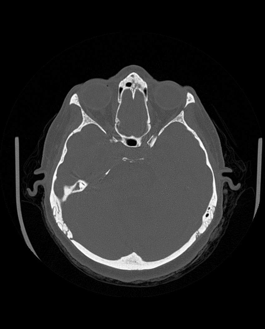 Automastoidectomy with labyrinthine fistula (Radiopaedia 84143-99411 Axial non-contrast 104).jpg