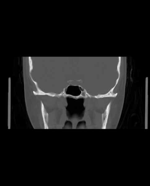 File:Automastoidectomy with labyrinthine fistula (Radiopaedia 84143-99411 Coronal non-contrast 72).jpg