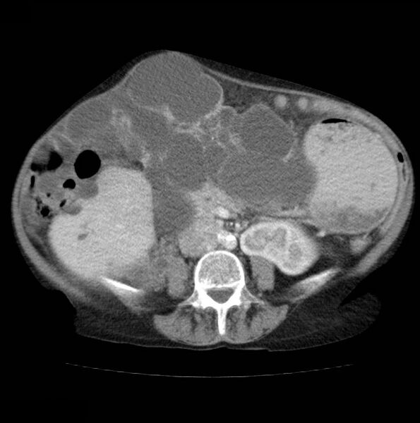 File:Autosomal dominant polycystic kidney disease (Radiopaedia 16777-16490 A 34).jpg