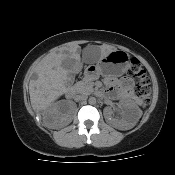File:Autosomal dominant polycystic kidney disease (Radiopaedia 23061-23093 Axial non-contrast 24).jpg