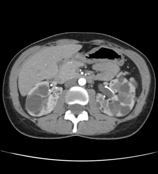 File:Autosomal dominant polycystic kidney disease - early onset (Radiopaedia 40734-43387 B 22).jpg