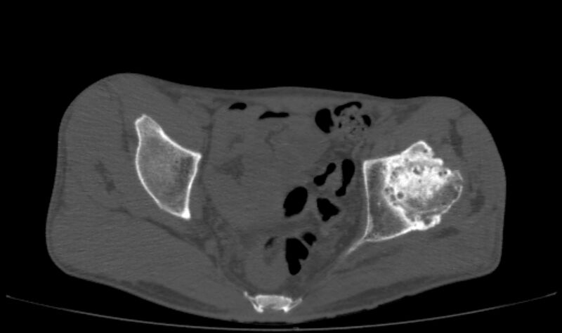 File:Avascular necrosis of the left hip (Radiopaedia 75068-86125 Axial bone window 25).jpg