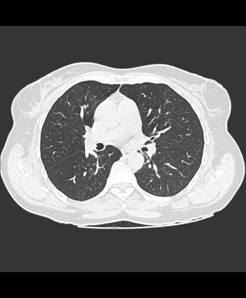 File:Azygos fissure and azygos lobe (Radiopaedia 41841-44832 Axial lung window 15).jpg
