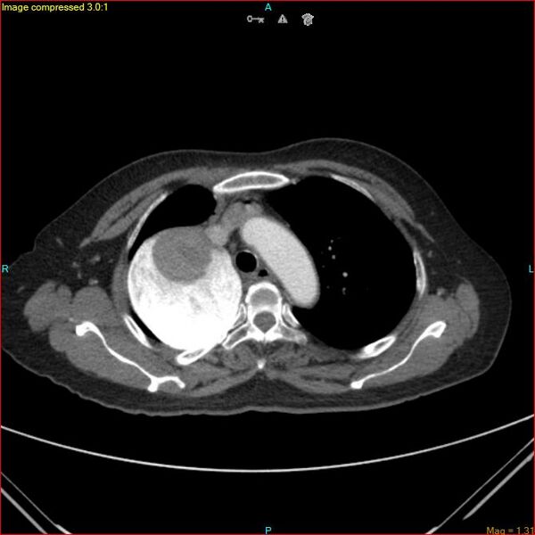 File:Azygos vein aneurysm (Radiopaedia 77824-90130 B 18).jpg