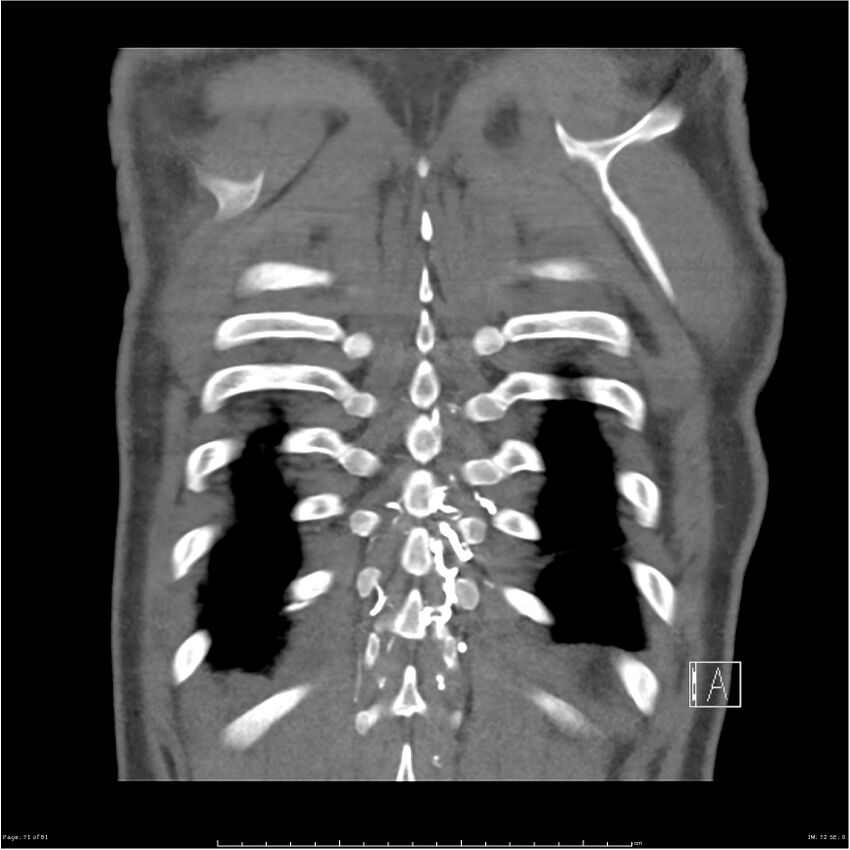 Azygos venous system anatomy (CT pulmonary angiography) (Radiopaedia 25928-26077 Coronal C+ CTPA 71).jpg