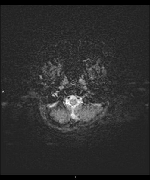 File:Basal ganglia and parenchymal ischemia (Radiopaedia 45818-50084 Axial SWI 2).jpg