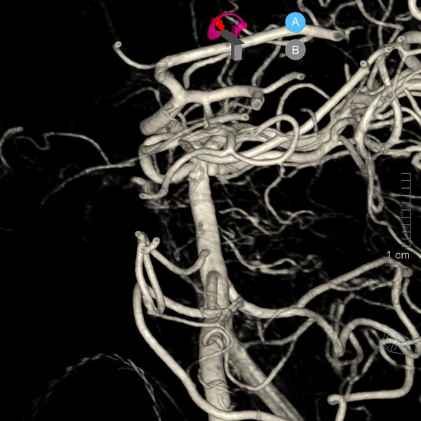 File:Basilar artery perforator aneurysm (Radiopaedia 82455-97734 3D view left VA 8).jpg