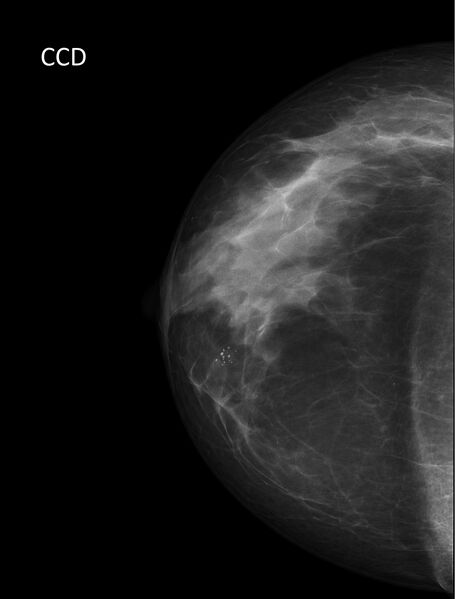 File:Benign breast clustered microcalcifications (Radiopaedia 84548-99945 CC 1).jpg
