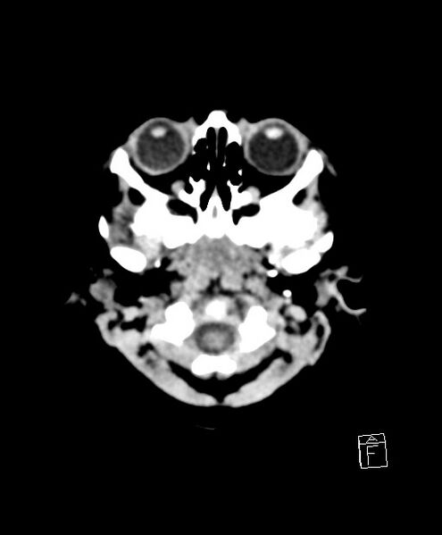 File:Benign enlargement of subarachnoid spaces in infancy (BESS) (Radiopaedia 87459-103795 Axial non-contrast 81).jpg
