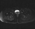 Bicornuate bicollis uterus (Radiopaedia 61626-69616 Axial PD fat sat 30).jpg
